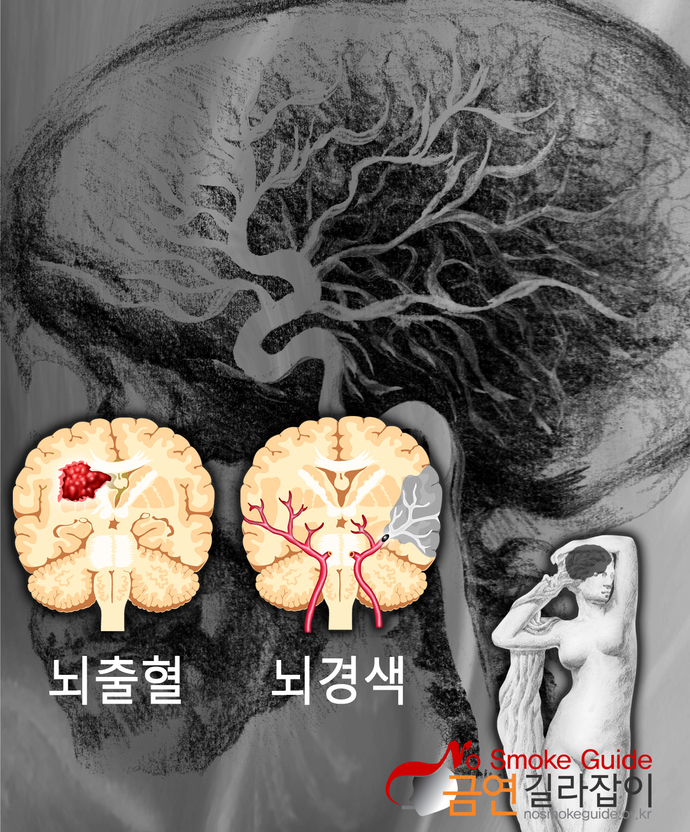 뇌혈관질환이미지