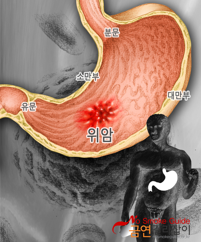 급성만성호흡기질환 이미지